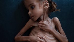 Yemen'de kolera salgını