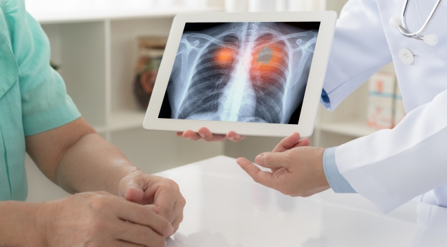 Amerikan Kanseri Derneği açıkladı; akciğer kanserinde tarama yaşı düştü