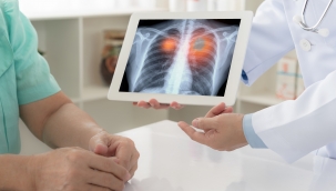 Amerikan Kanseri Derneği açıkladı; akciğer kanserinde tarama yaşı düştü